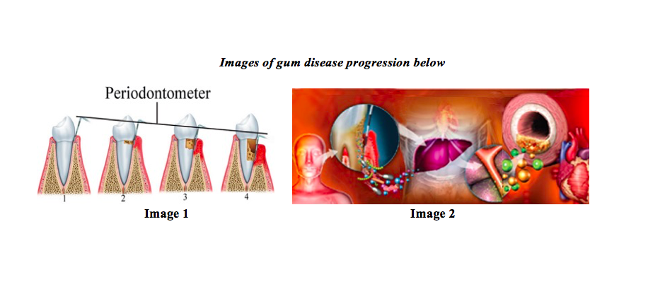Gum disease images